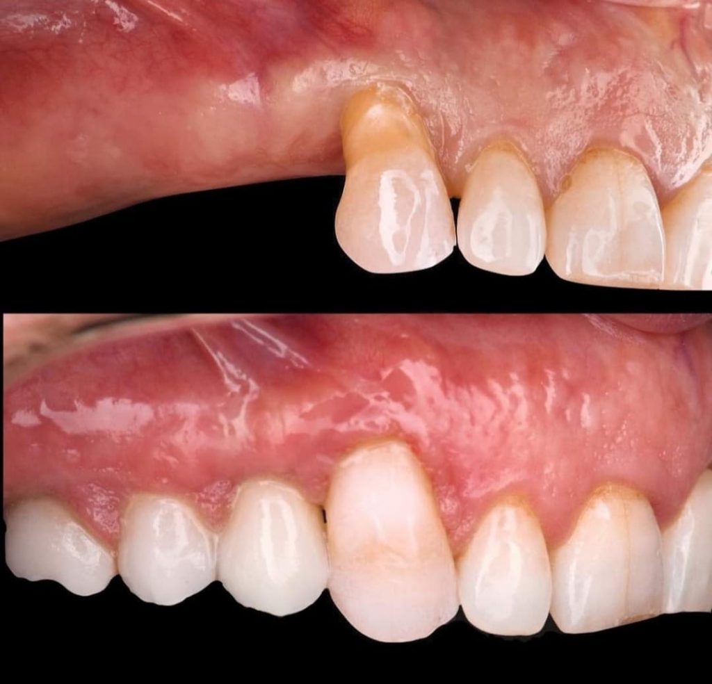 i casi clinici eseguiti presso lo studio dentistico del dott. taddia a novara