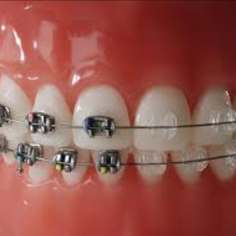 ortodonzia eseguita presso lo studio dentistico del dott. taddia a novara